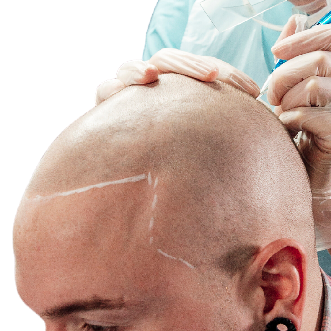 SCALP MICROPIGMENTATION